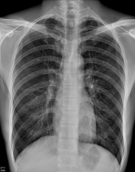 Sifrovoy rentgen apparat 6600 Generator 56kW Siemens trubka