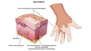 Мазь от витилиго Хуаяаотан