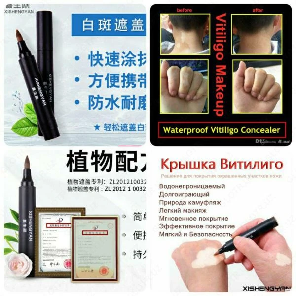 Vitiligo uchun ohang belgisi Ko'rinadigan effekt