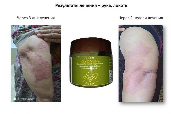 Крем Psonur от псориаза