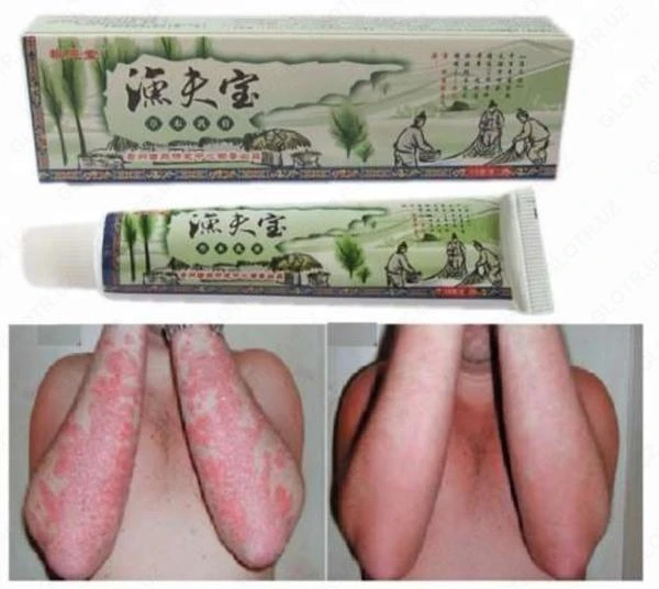 Psoriaz, dermatit, liken, qichishish uchun "baliqchining xazinasi" malhami