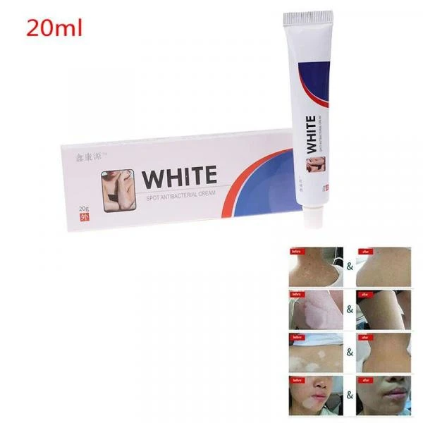 Антибактериальный китайский крем от витилиго