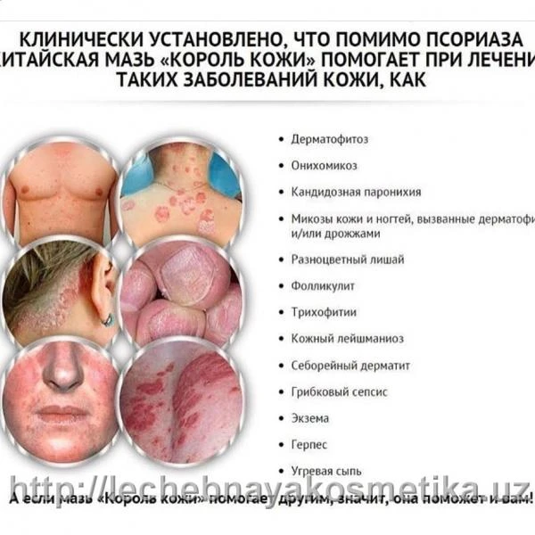 Тайская мазь «Король кожи и псориаза»