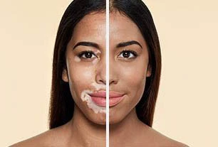 Vitiligo va pigmentatsiya uchun krem "Xarraz"