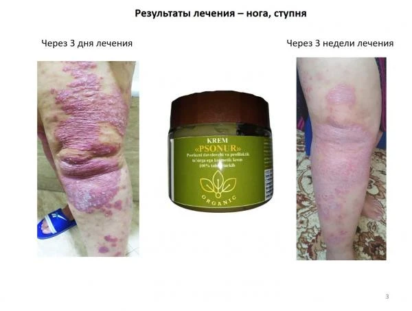 Крем Psonur от псориаза