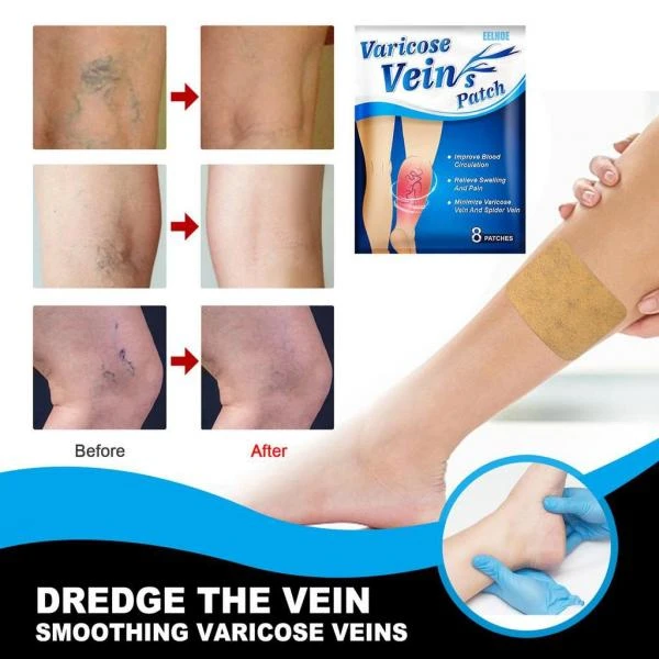 Patchi ot varikoznogo rasshireniya ven