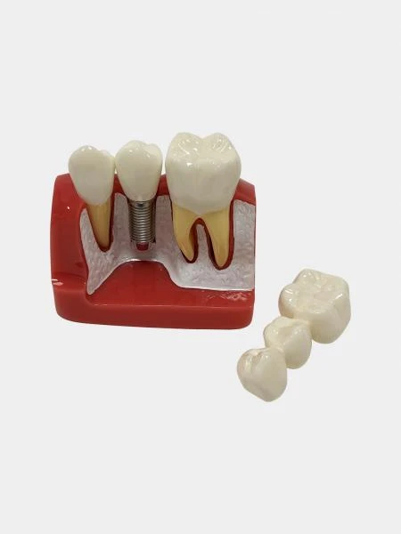 Муляж Implant analysis model with bridge/Модель анализа имплантата с мостом (Розовый)