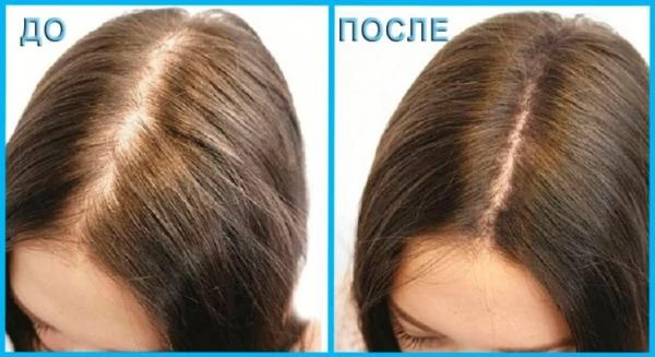 Ayollar uchun Minoxidil 10% spreyi