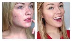 Гель от прыщей Xi fei shi