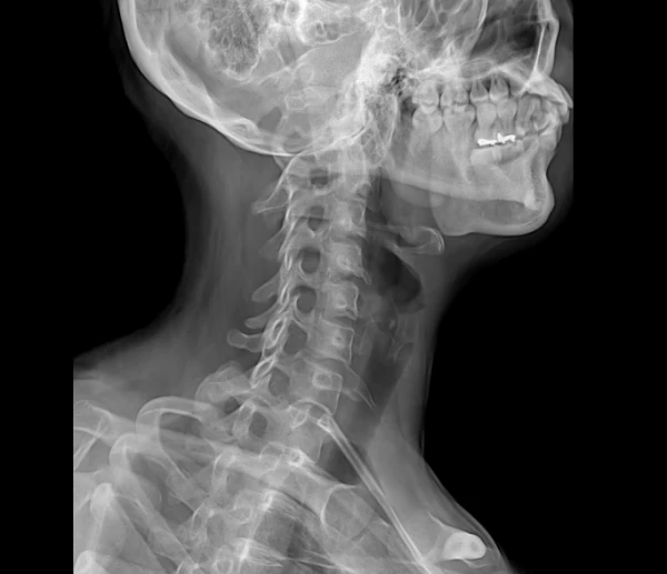 Цифровой рентген аппарат 6600 (56kW Siemens трубка)