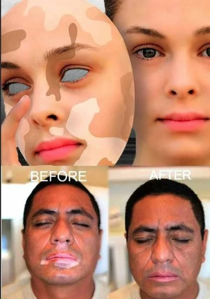 Пигменто натуральные таблетки для лечения пигментации кожи