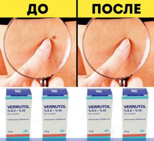 Веррутол (Verrutol) от папилом