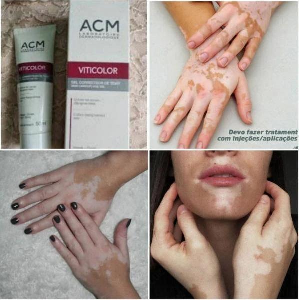 Vitiligo uchun Viticolor kamuflyaj geli