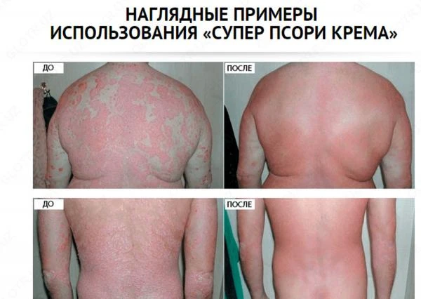 Крем "Супер Псори"от псориаза