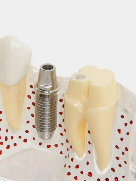 Муляж Implant analysis model with bridge