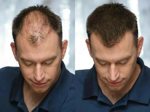 Laringoskop tipa Makintosh 4 klinka