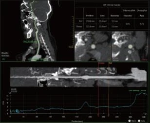 Multispiralniy Kompyuterniy tomograf  model: NeuViz 64