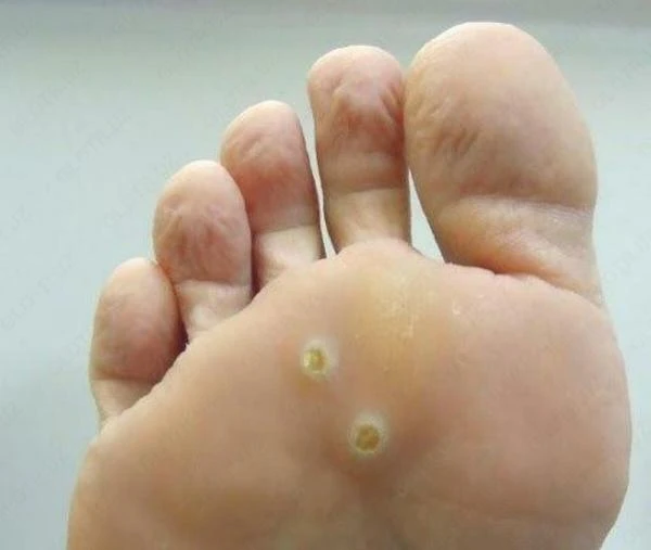 Веррутол (Verrutol) препарат от бородавок и папилом