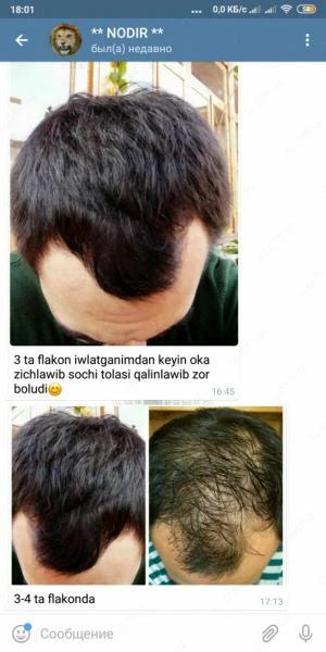 Minoxidil Kirkland - Sredstvo dlya rosta volos i borodi