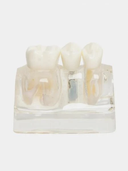 Муляж Implant analysis model with bridge