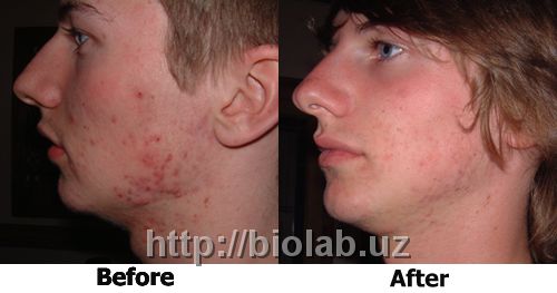 Rugby Acne Medic Protiv ugrevoy sipi