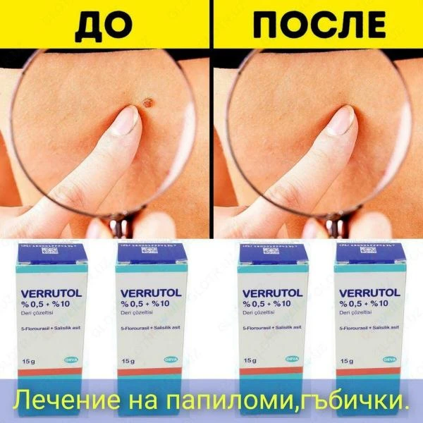 Веррутол (Verrutol) препарат от бородавок и папилом