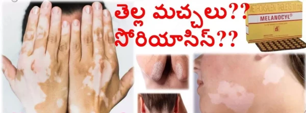 Melanocyl таблетки, супер натуральные таблетки от белых пятен витилиго - Original