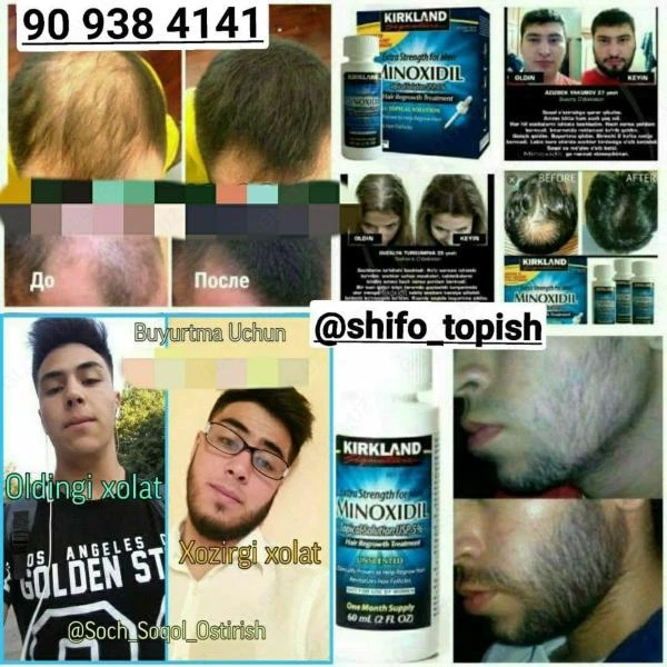 Minoxidil Kirklad 5% - Sredstvo protiv obliseniya